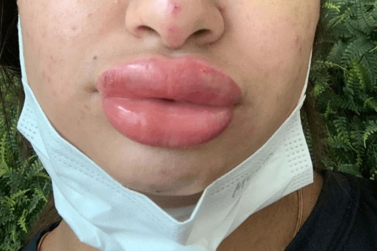 Falsa biomédica é acusada por mais de 30 mulheres após complicações graves em procedimentos estéticos em SC