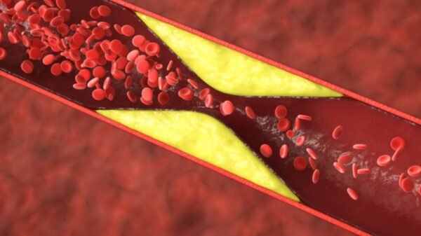 No Dia Nacional de Combate ao Colesterol, cardiologista do Huol alerta para riscos e destaca importância do diagnóstico precoce.