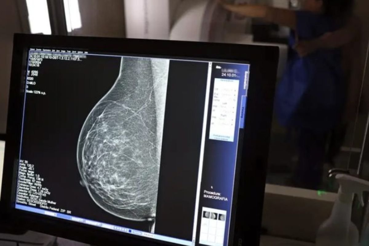 Mamografia no SUS passa a ser garantida para mulheres a partir dos 40 anos após sanção da Lei nº 15.284, publicada no Diário Oficial da União.