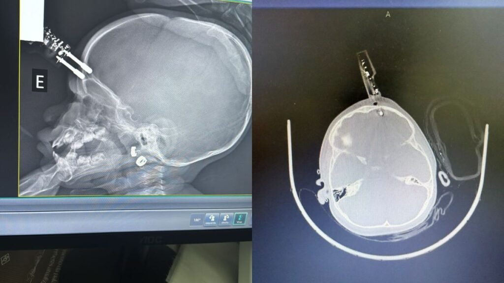 Menina de 1 ano passou por cirurgia de urgência após cair da cama e ter carregador de celular cravado na testa, em Divinópolis.
