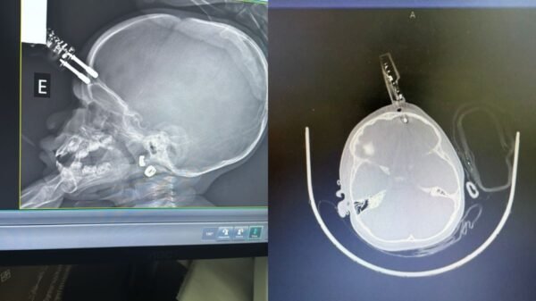 Menina de 1 ano passou por cirurgia de urgência após cair da cama e ter carregador de celular cravado na testa, em Divinópolis.