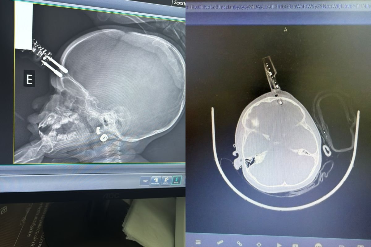 Menina de 1 ano passou por cirurgia de urgência após cair da cama e ter carregador de celular cravado na testa, em Divinópolis.